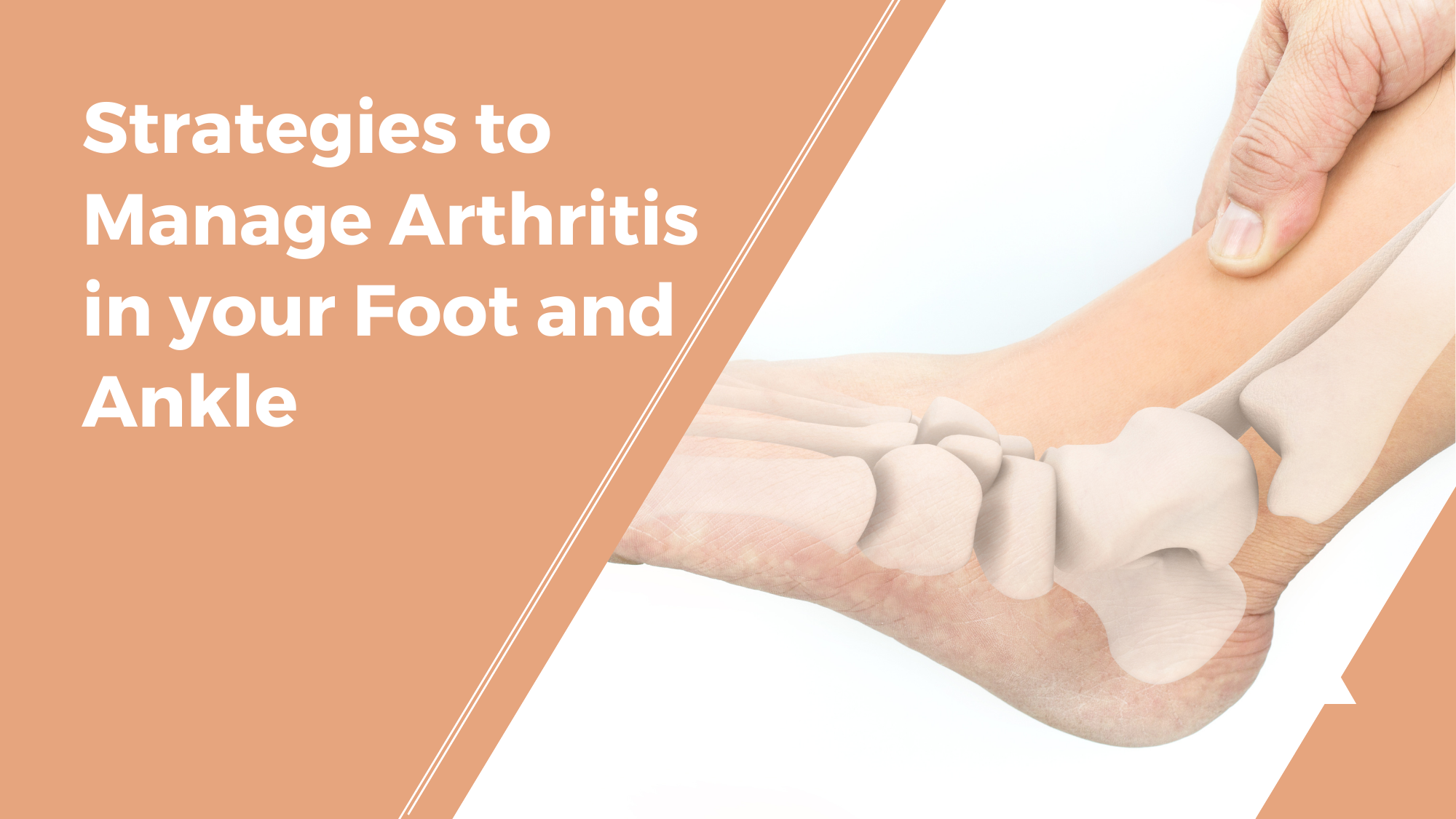 Strategies to Manage Arthritis in your Foot and Ankle